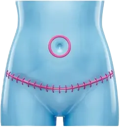 ابدومینوپلاستی