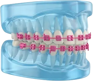 ارتودنسی ثابت فلزی