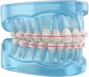 ارتودنسی سرامیکی