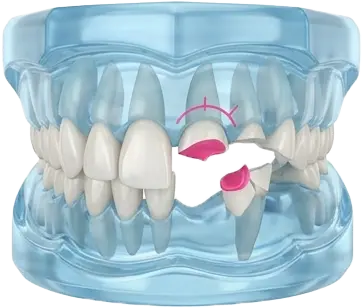 باندینگ دندان