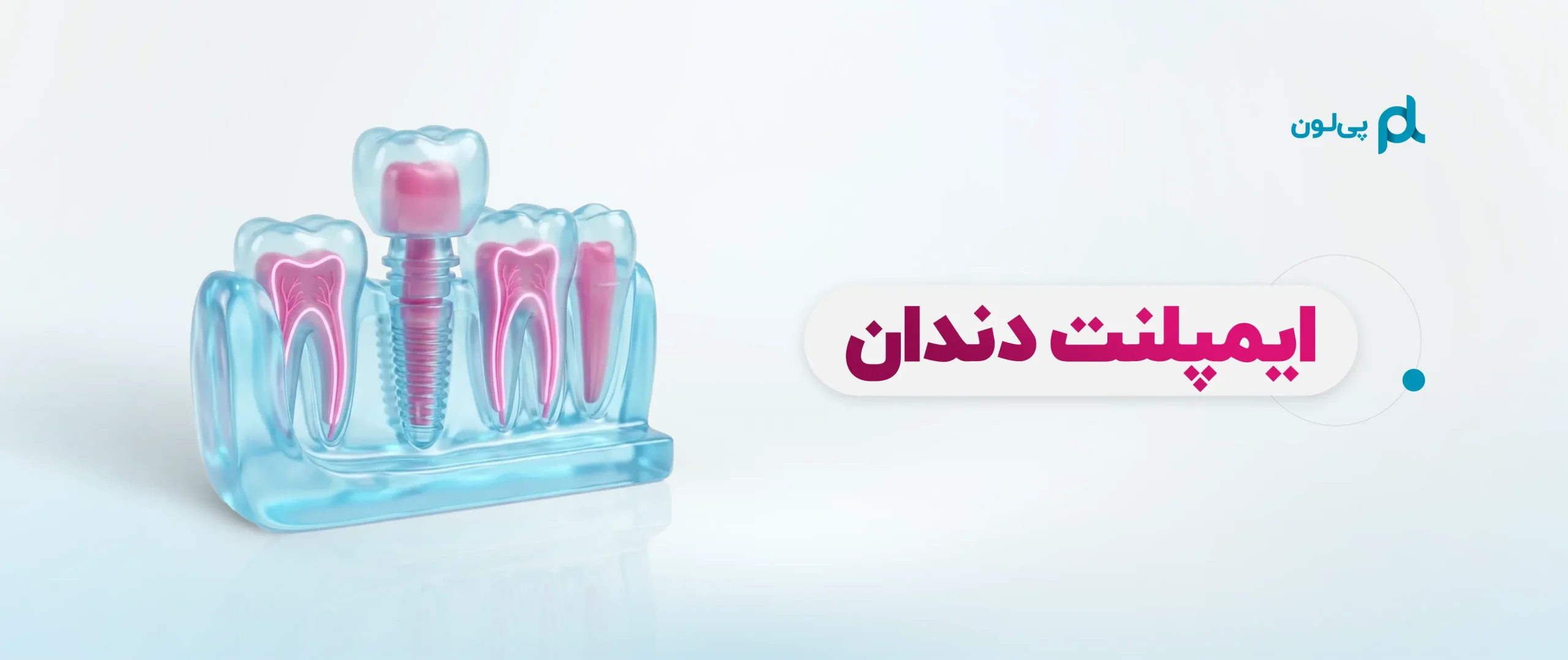 بنر ایمپلنت دندان