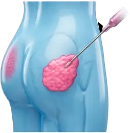 تزریق چربی