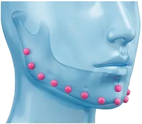 زاویه سازی با تزریق ژل